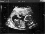 http://forummamici.ro/comunitate/uploads/thumbs/15436_baby_scan_week17_1.jpg