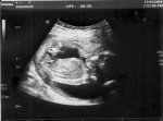 http://forummamici.ro/comunitate/uploads/thumbs/15436_baby_scan_week17_2.jpg