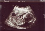 http://forummamici.ro/comunitate/uploads/thumbs/15436_baby_scan_week17_4.jpg